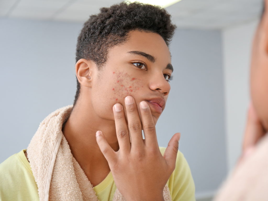 Beyond the Breakout: A Science-Based Approach to Conquering Acne