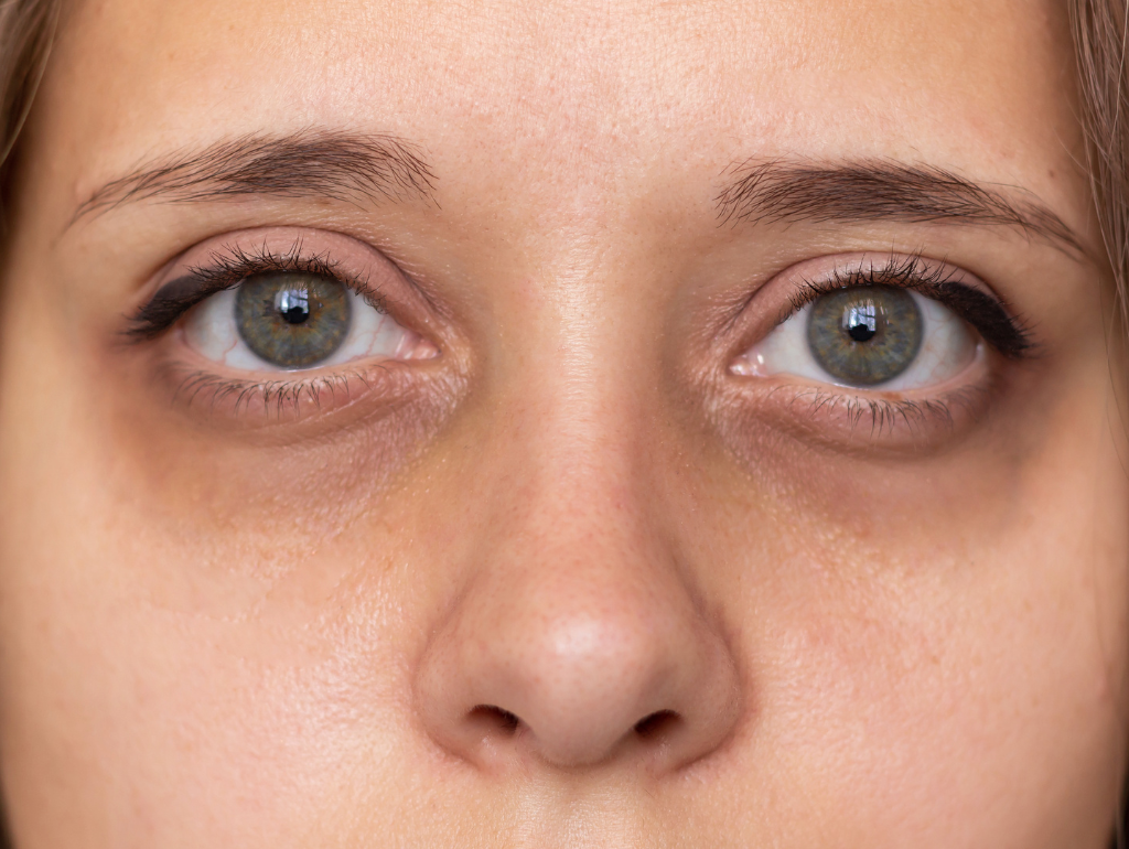 Shadows Beneath: Understanding and Treating Under-Eye Dark Circles at Any Age