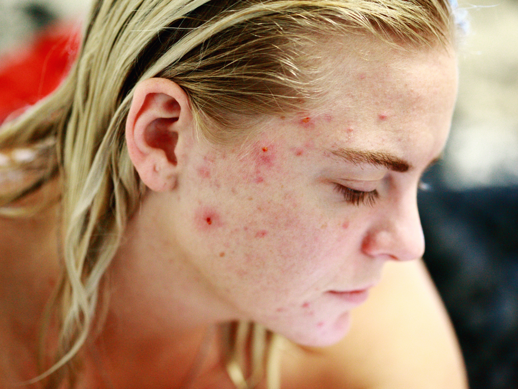 Dealing with Acne: Skincare Tips for Oily Skin