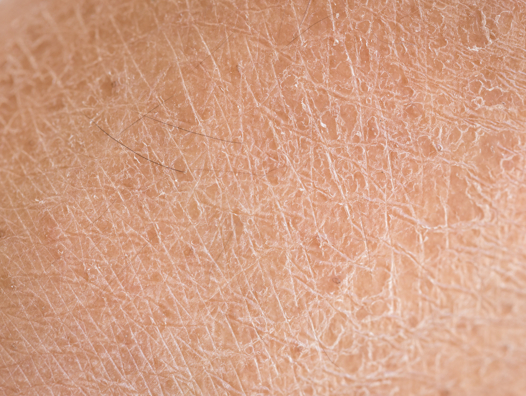 Thirsty Skin: How to Recognize and Restore Dehydrated Skin (Even When It's Oily)