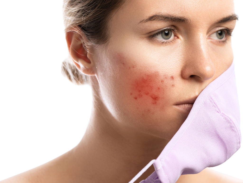 Monthly Breakout Cycle: Breaking Free from Hormone-Driven Acne