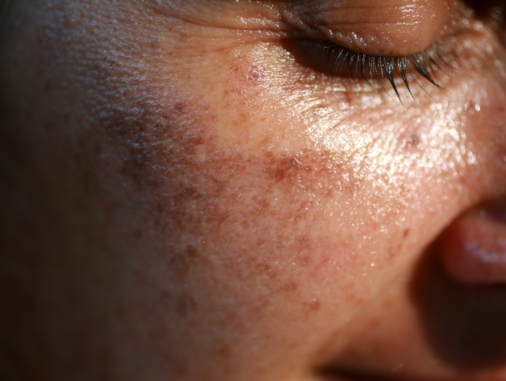 How Hormones Affect Skin Tone and Pigmentation