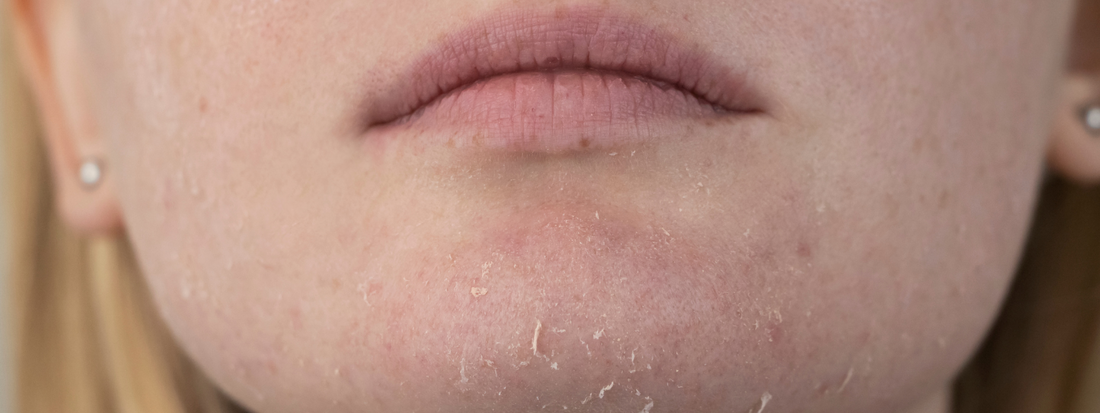 How to Balance Oily and Dry Areas on Combination Skin