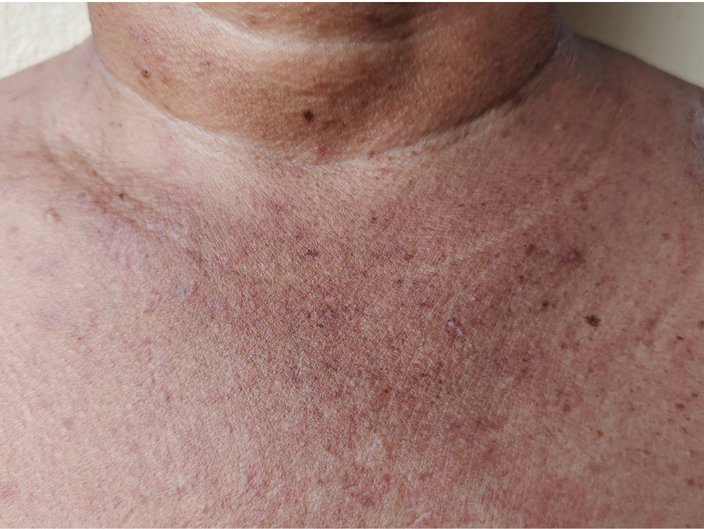 How to Prevent Dark Spots and Uneven Skin Tone