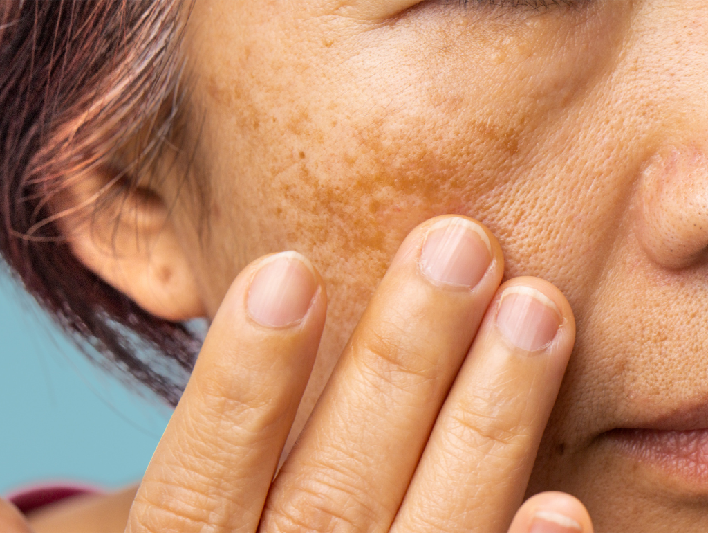 The Mask of Pregnancy and Beyond: Understanding and Managing Stubborn Melasma