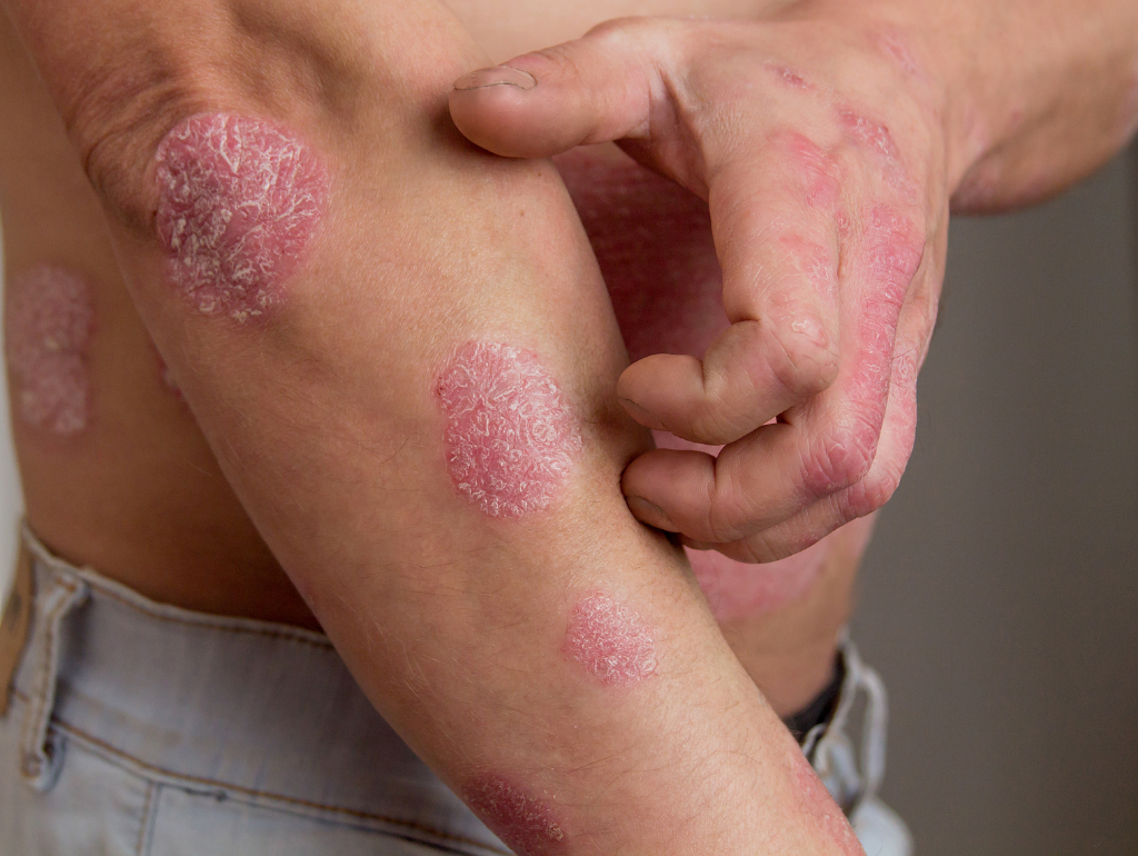 Living Comfortably in Your Skin: Gentle Management Approaches for Psoriasis