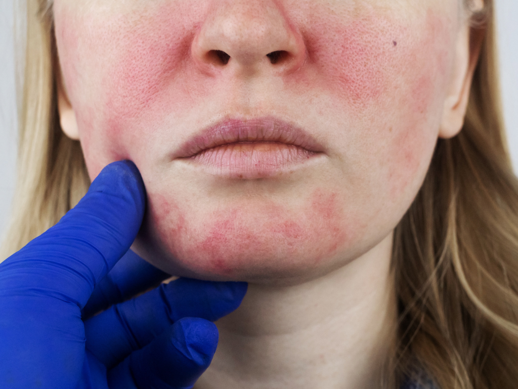 Beyond Blushing: Understanding and Managing Rosacea Triggers
