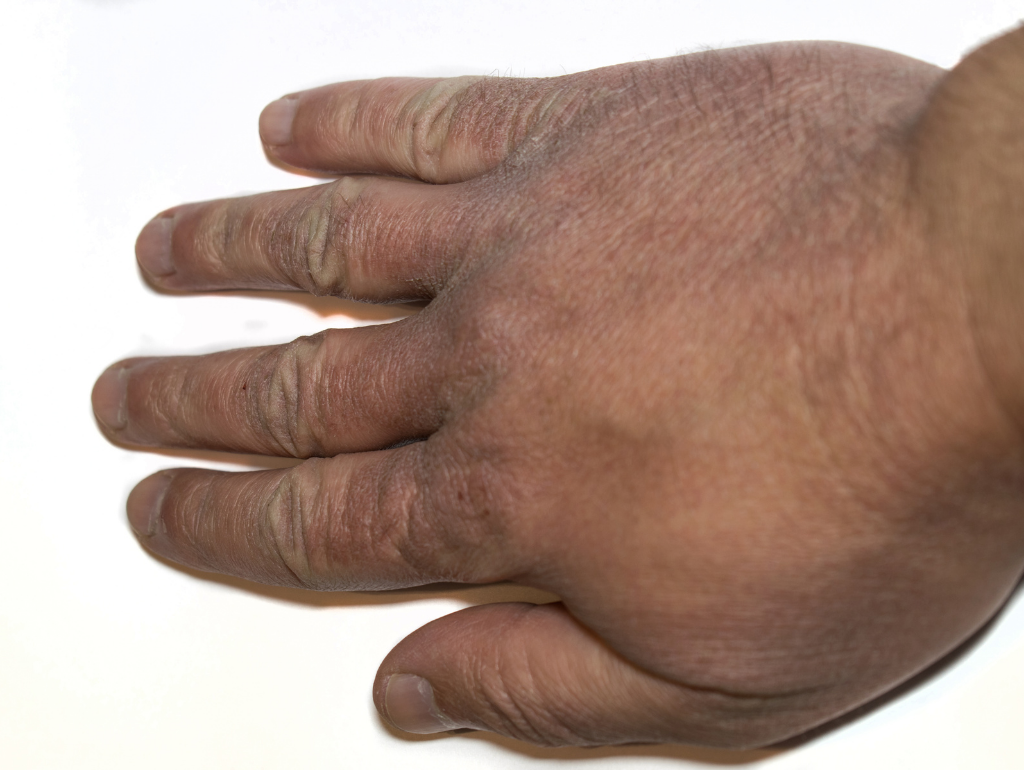 Ashiness: When Your Skin Loses Its Natural Warmth