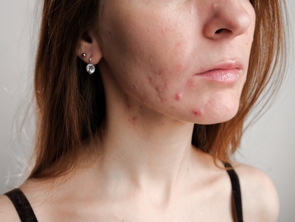 Cystic Acne: The Deep, Painful Truth About Your Skin's Most Aggressive Breakouts