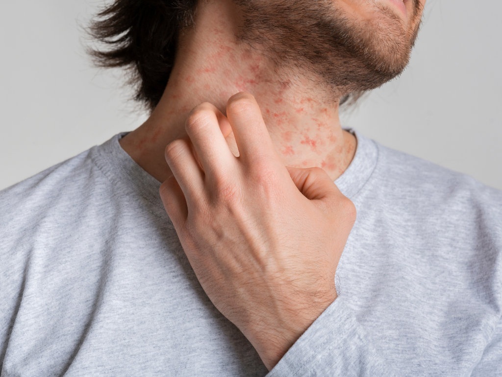 Eczema: When Your Skin Becomes Its Own Worst Enemy