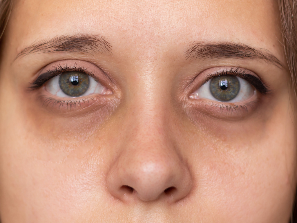 Hollow-looking Eyes: When Your Eyes Seem to Disappear Into Your Face