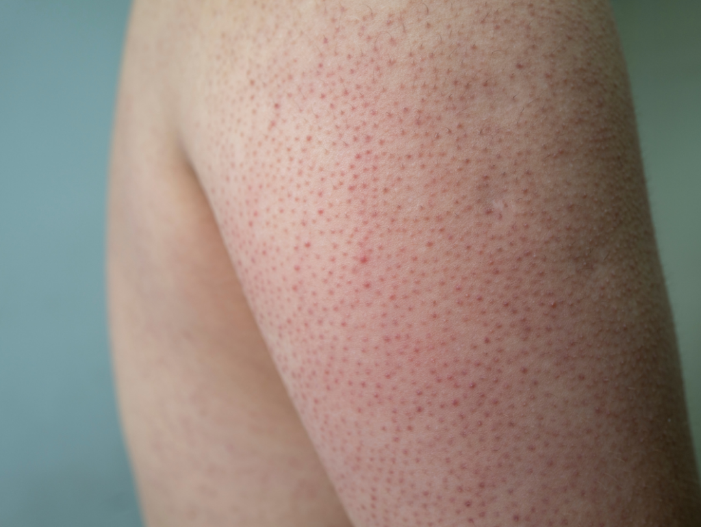 Keratosis Pilaris (Bumpy Skin): When Your Arms Feel Like a Plucked Chicken