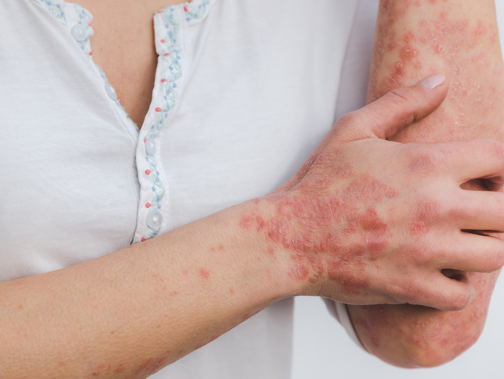 Psoriasis: When Your Skin Goes Into Overdrive