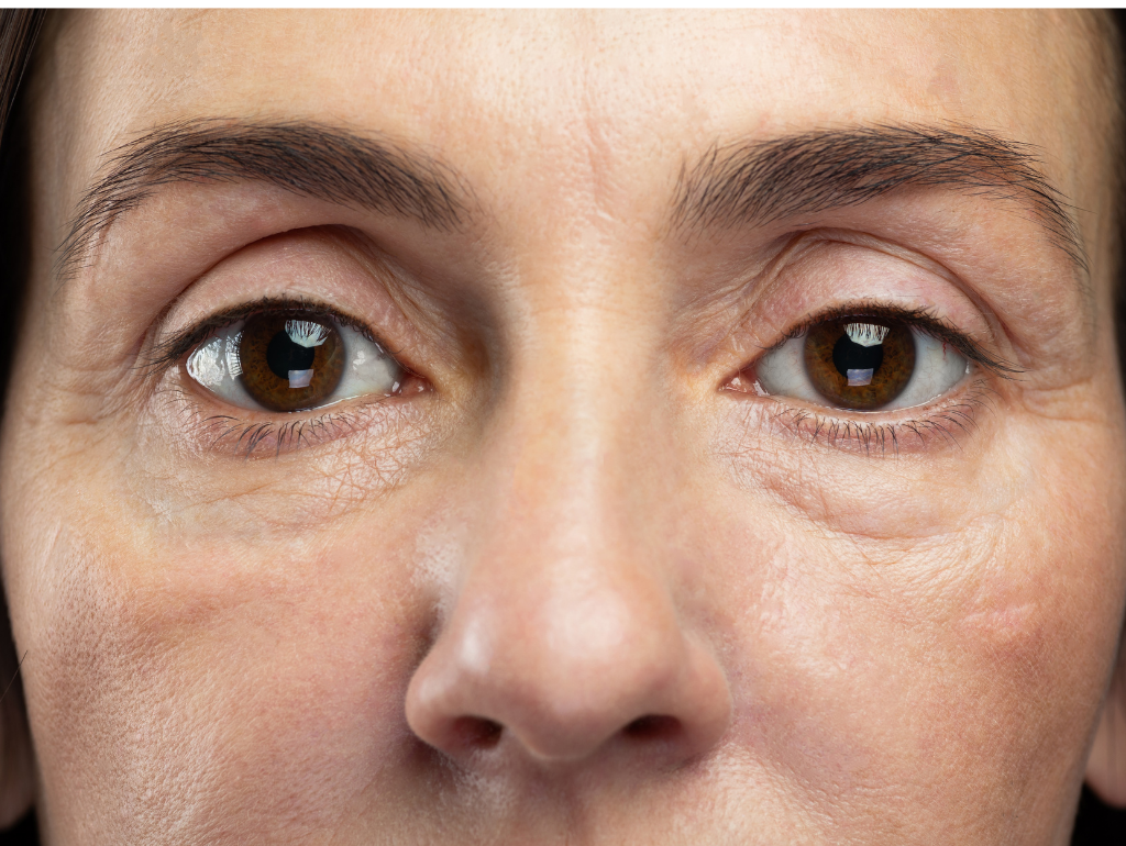 Puffy Eyes: When Your Eyes Look Like They're Storing Secrets