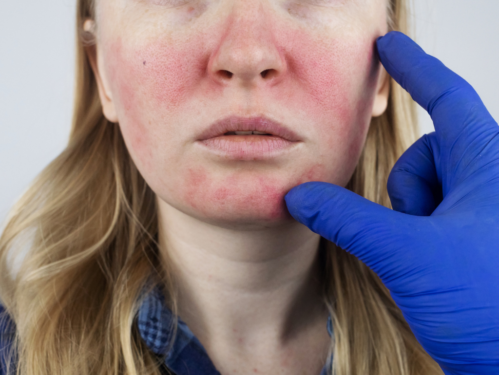Rosacea: When Your Face Develops Its Own Weather System
