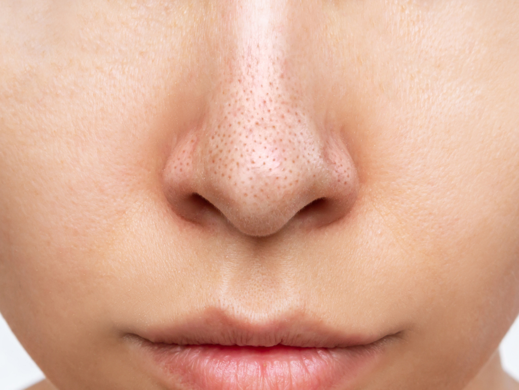 The Truth About Those Tiny White Bumps on Your Face (And How to Finally Get Rid of Them)